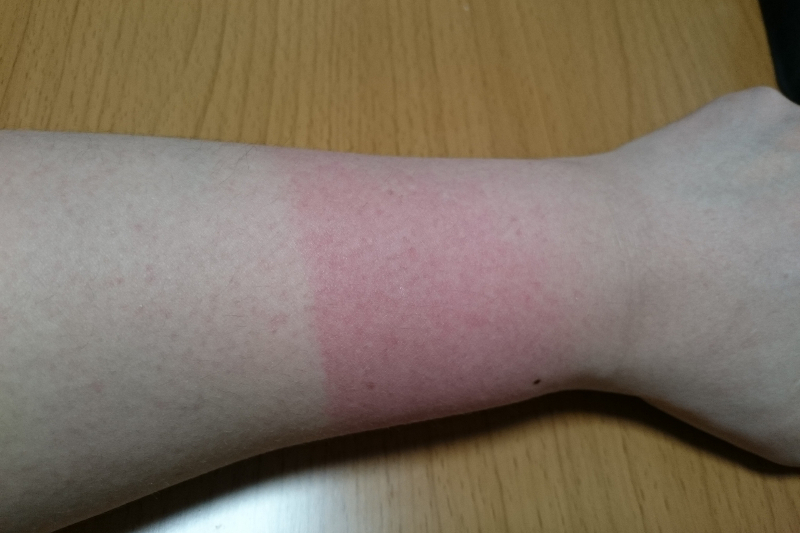 やけど・擦り傷・切り傷
